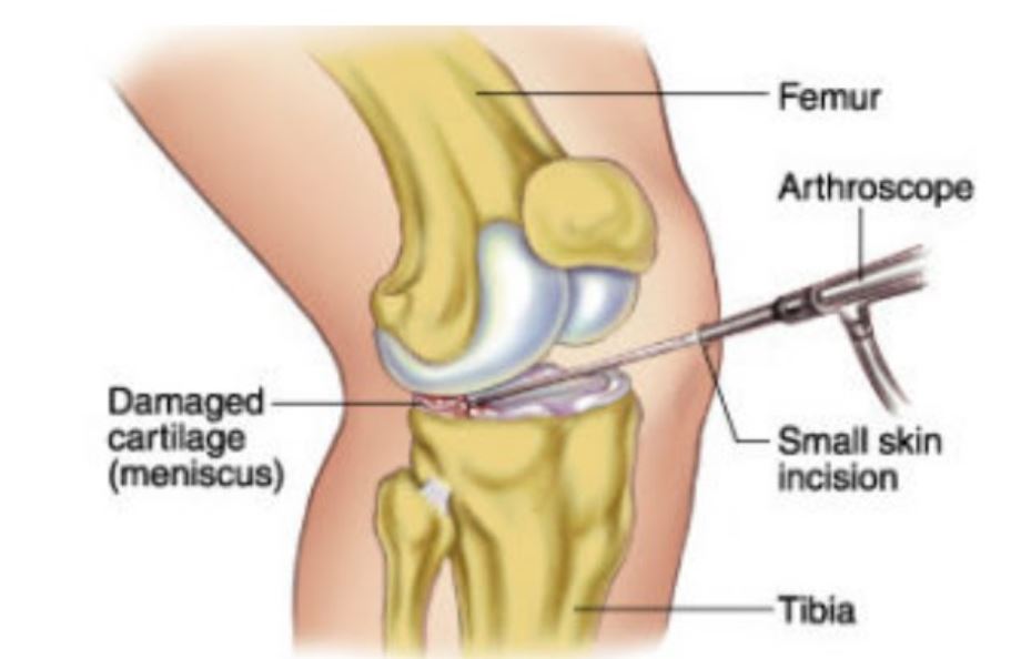 Arthroscopy and Sports Medicine